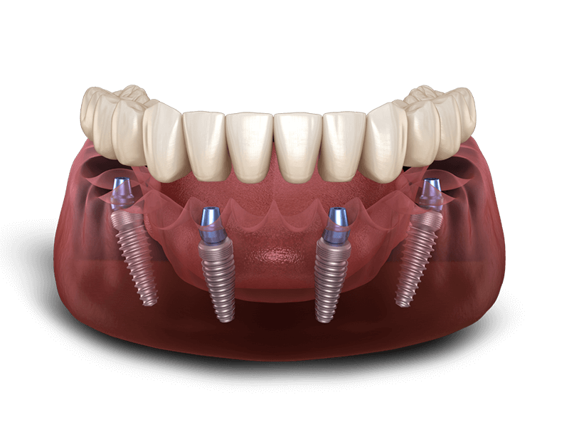 all-on-4® full arch restoration