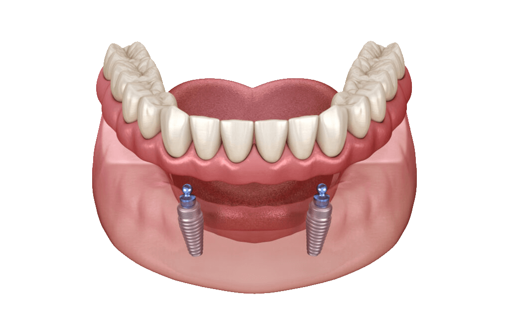 acrylic overdenture