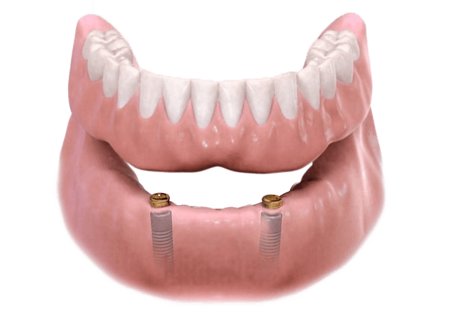 fixed teeth Vs. removable