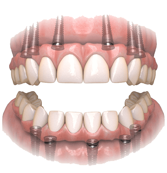 teeth-in-a-day options