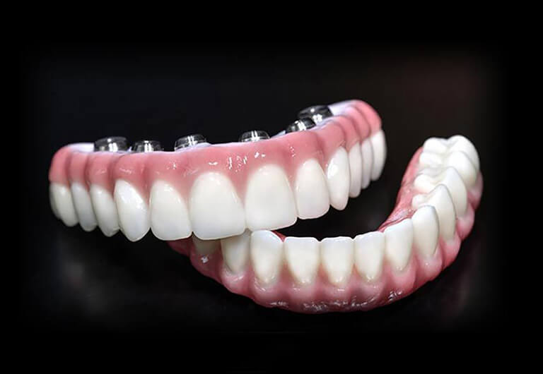 what are dental implants