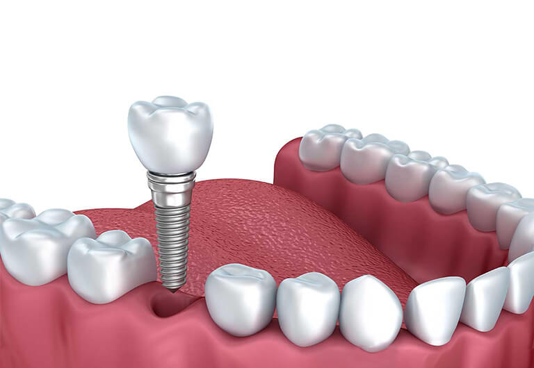 single tooth implants