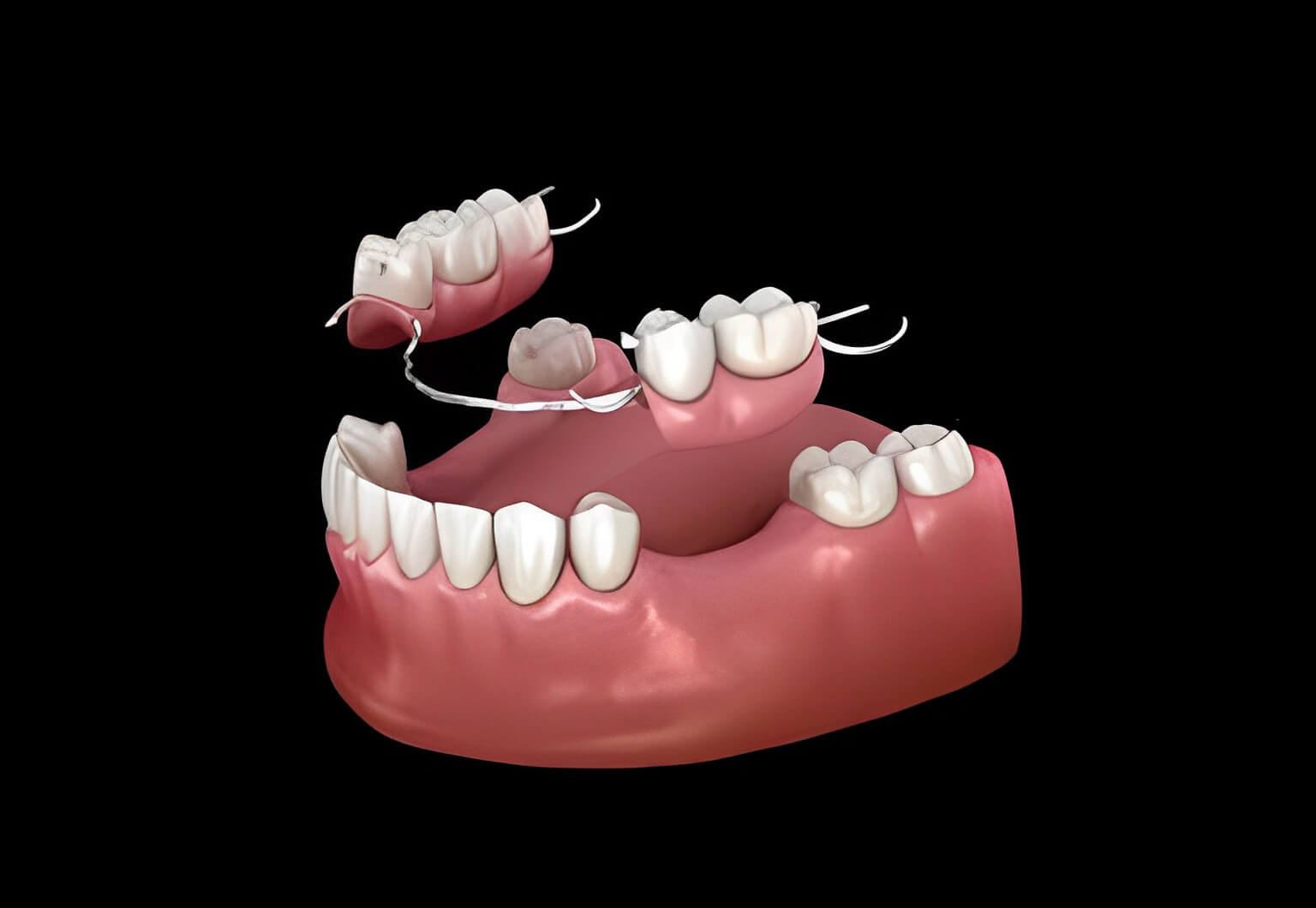 flexible partial dentures