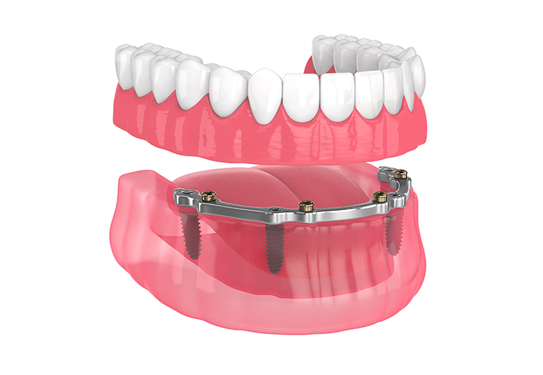 implant-supported overdentures