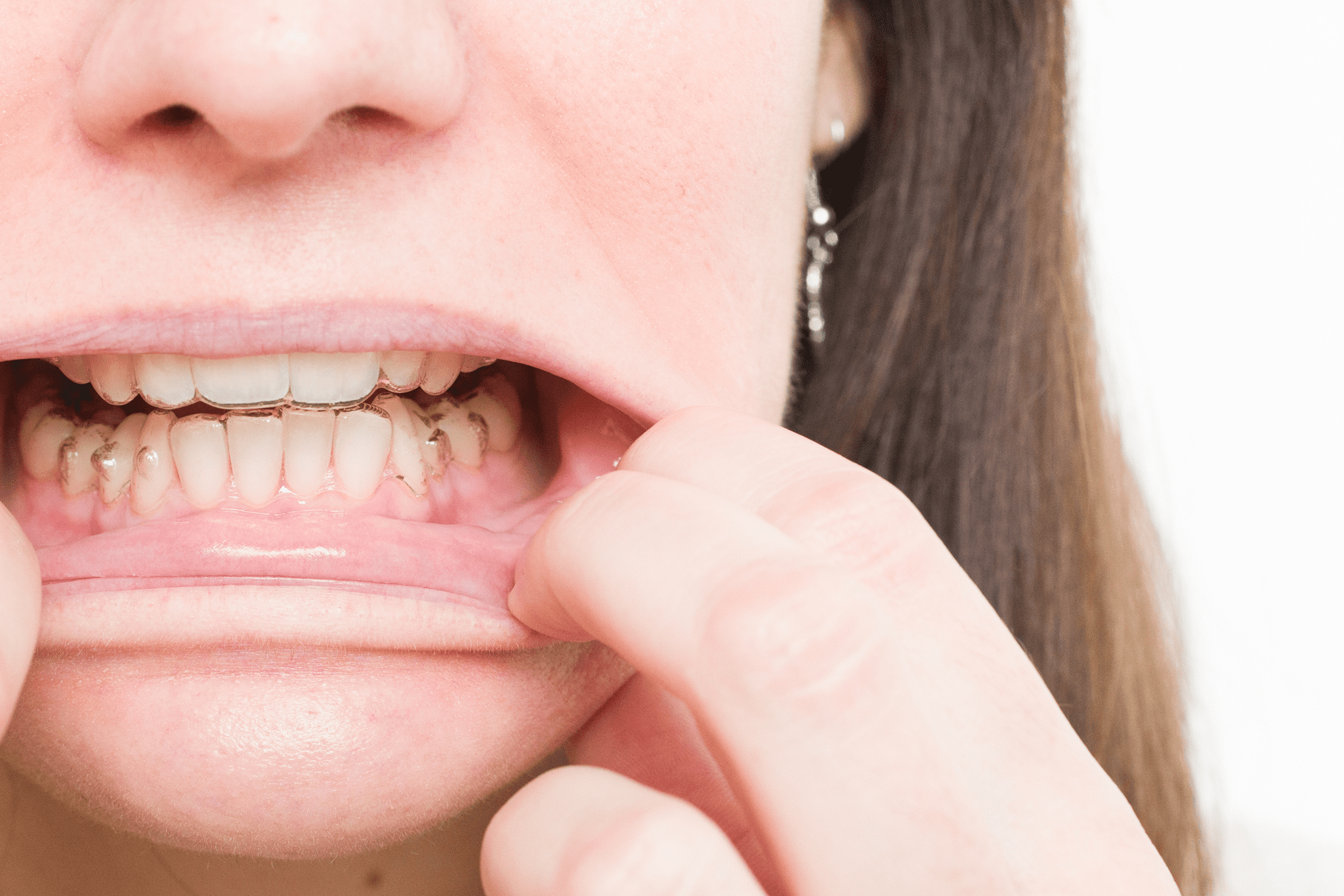 Close-up of mouth showing clear aligners