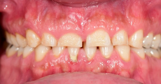 Close-up of missing and misaligned teeth